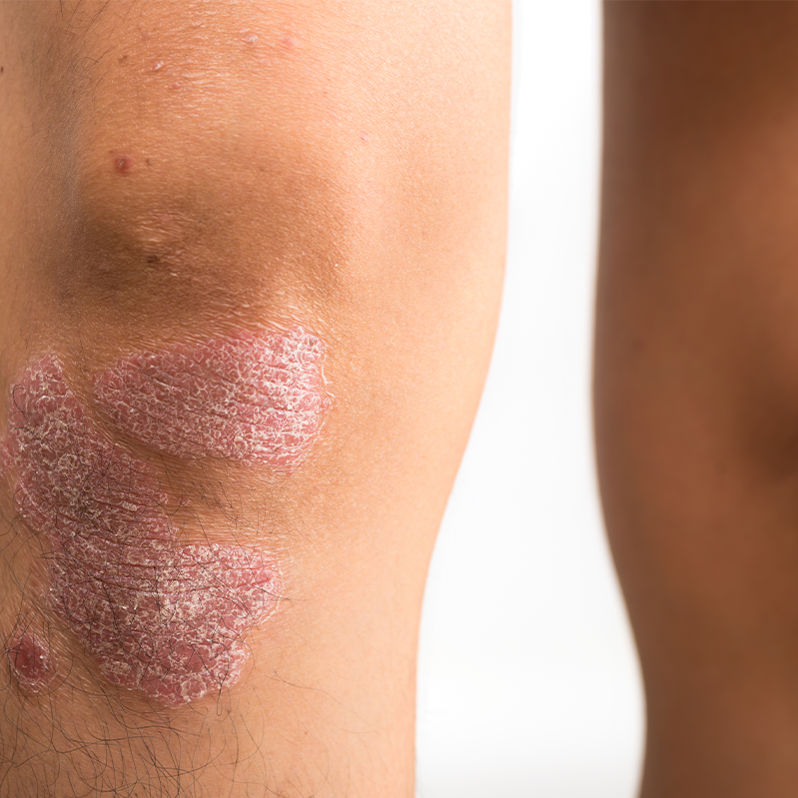 Ayurvedic psoriasis treatment in Dubai using natural skin therapies